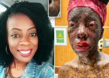 Mulher tem reação alérgica a antibiótico e fica irreconhecível: “me senti um monstro”