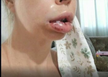 Dentista é acusada de deformar rosto de 18 pacientes