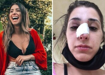 Modelo é espancada por companheiro ao terminar namoro e fica com rosto deformado