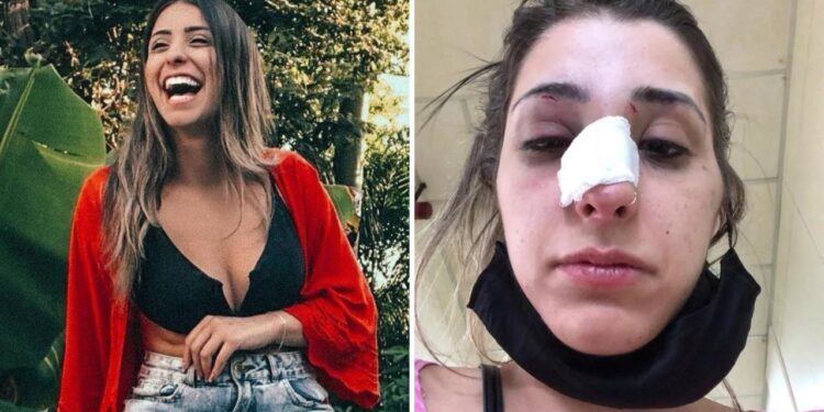 Modelo é espancada por companheiro ao terminar namoro e fica com rosto deformado