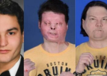 Primeiro transplante de rosto e mãos do mundo é realizado com sucesso