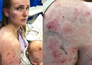 Mãe usa o próprio corpo para proteger bebê de tempestade de granizo