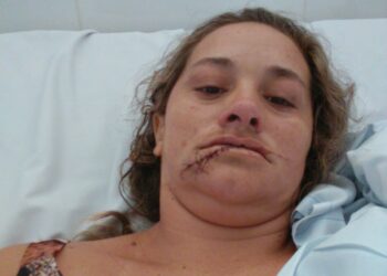 Mulher precisa de reconstituição da gengiva após ser brutalmente espancada pelo ex-companheiro