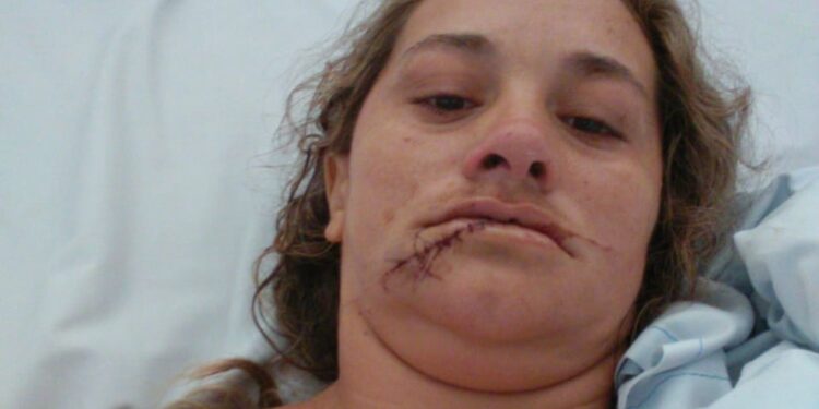Mulher precisa de reconstituição da gengiva após ser brutalmente espancada pelo ex-companheiro