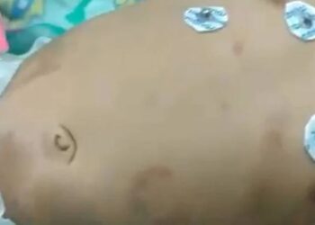 Bebê de 2 meses sofre lesão no crânio após ser espancado pelo pai por chorar demais