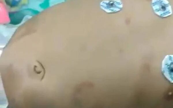 Bebê de 2 meses sofre lesão no crânio após ser espancado pelo pai por chorar demais