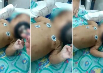 Bebê perde rim ao ser espancado pelo próprio pai por causa de choro excessivo