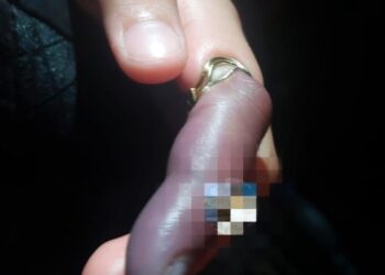 Em Manaus, PM socorre criança que teve dedo quae necrosado ao prender argola na mão