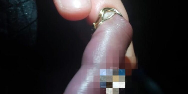 Em Manaus, PM socorre criança que teve dedo quae necrosado ao prender argola na mão