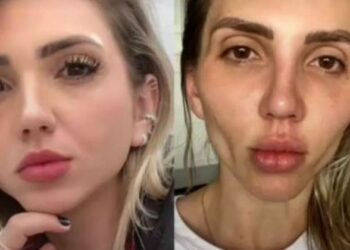 Influenciadora fica com rosto desfigurado por causa de procedimento estético: ‘minha cara caiu’