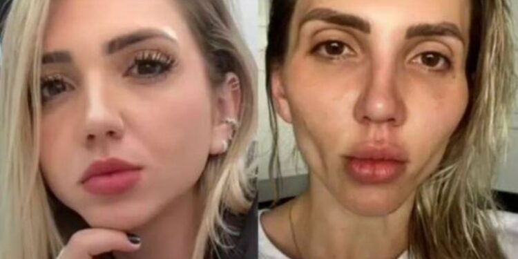 Influenciadora fica com rosto desfigurado por causa de procedimento estético: ‘minha cara caiu’