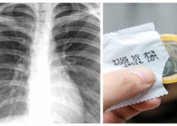 Mulher vai ao médico com suspeita de tuberculose e descobre camisinha no pulmão