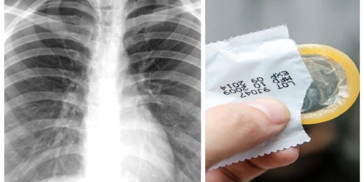 Mulher vai ao médico com suspeita de tuberculose e descobre camisinha no pulmão