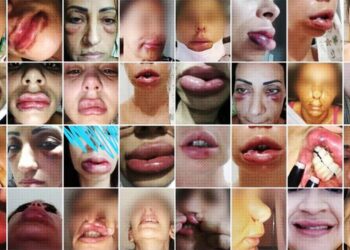 Dentista é acusada de deformar rosto de 40 mulheres após harmonização facial