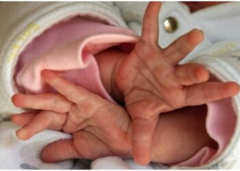 Bebê tem fêmur quebrado e costelas fraturadas pelos pais