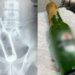Após bebedeira, jovem enfia garrafa de cerveja no ânus e vai parar no pronto-socorro