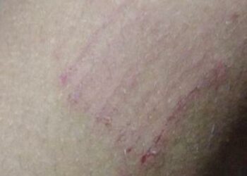 Familiares de adolescentes denunciam agressões e tortura da polícia no interior do AM