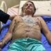 Presidente Bolsonaro é transferido para São Paulo e pode passar por nova cirurgia