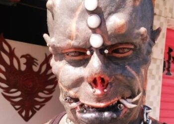 ‘Diabão’ tem complicações e deve passar por nova cirurgia