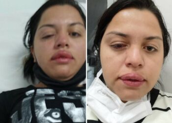 Faxineira atacada com ácido por ex-patrão teme perder a visão