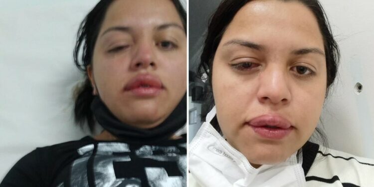 Faxineira atacada com ácido por ex-patrão teme perder a visão