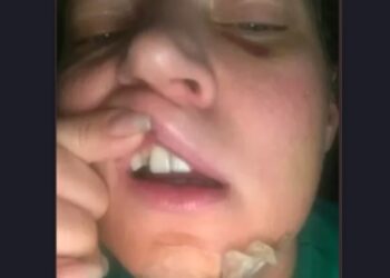 Joice Hasselmann acorda com fraturas em meio a poça de sangue e suspeita de atentado