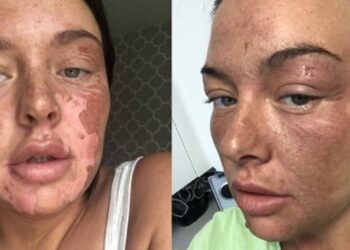 Mulher tem rosto queimado ao tentar fazer truque do TikTok