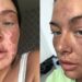 Mulher tem rosto queimado ao tentar fazer truque do TikTok