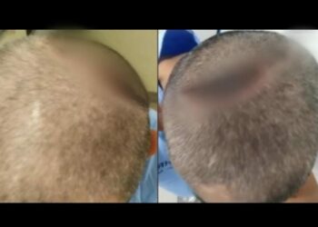 Homem é intubado com Covid-19 e acorda com a cabeça quebrada