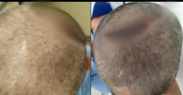 Homem é intubado com Covid-19 e acorda com a cabeça quebrada