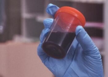 FVS-RCP investiga 11 casos suspeitos da ‘doença da urina preta’ em Itacoatiara