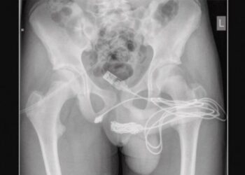 Adolescente vai parar em mesa de cirurgia após tentar medir pênis com cabo de USB