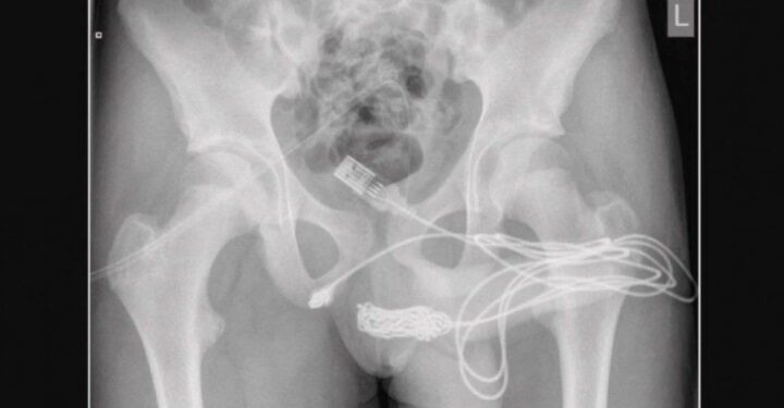 Adolescente vai parar em mesa de cirurgia após tentar medir pênis com cabo de USB