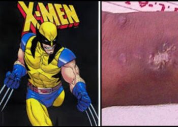 Adolescente é hospitalizado após injetar mercúrio nas veias para virar X-Men