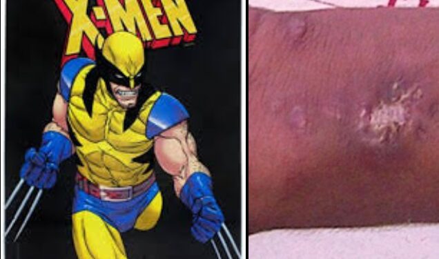 Adolescente é hospitalizado após injetar mercúrio nas veias para virar X-Men