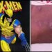Adolescente é hospitalizado após injetar mercúrio nas veias para virar X-Men
