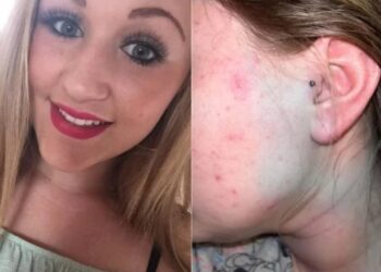 Perigo: Jovem tem inflamação e fica com rosto azul após colocar piercing