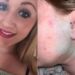 Perigo: Jovem tem inflamação e fica com rosto azul após colocar piercing