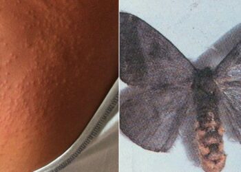 Mariposas causam surto de coceira e lesões em pele de moradores de Recife