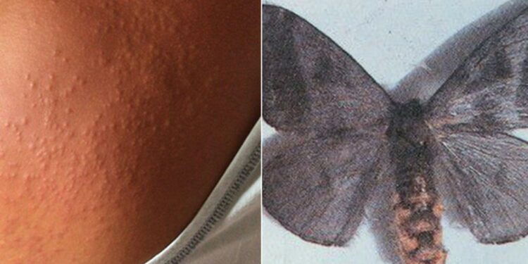 Mariposas causam surto de coceira e lesões em pele de moradores de Recife