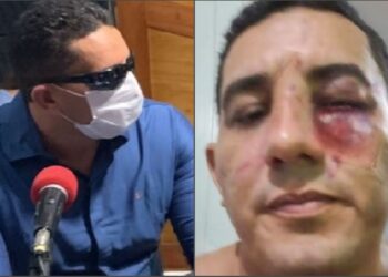 Ao ser massacrado em luta por ex-vereador, prefeito de Borba tenta disfarçar hematomas com óculos escuros e máscara