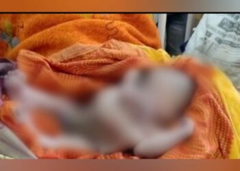 Na Índia, bebê nasce com quatro braços e quatro pernas; veja as imagens