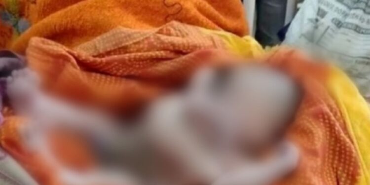 Na Índia, bebê nasce com quatro braços e quatro pernas; veja as imagens