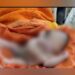 Na Índia, bebê nasce com quatro braços e quatro pernas; veja as imagens