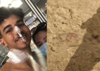 Jovem dorme em praia e acorda com barriga aberta e parte do intestino para fora do corpo