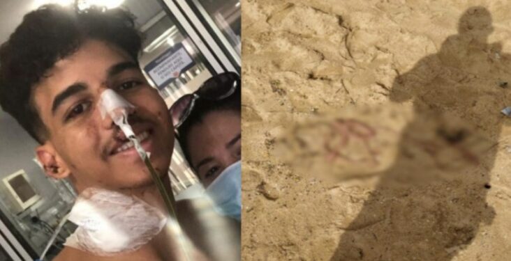 Jovem dorme em praia e acorda com barriga aberta e parte do intestino para fora do corpo