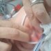 Familiares encontram larvas na boca e nariz de idosa internada em UTI de hospital universitário