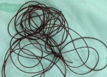 Homem é internado após enfiar fio de nylon no ‘bigulim’ durante masturbação