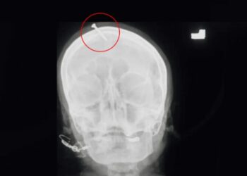 Grávida martela prego na própria cabeça após curandeiro ‘dar dica’ para bebê nascer menino