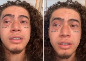 Whindersson Nunes mostra olhos vermelhos após luta com Popó e brinca: “Ele passou conjuntivite”